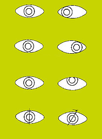 Graphique Strabisme avec différentes positions erronées de l'œil
